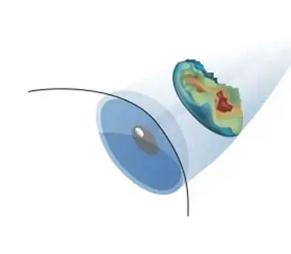 Advanced Customized Blade Free Lasik Surgery (ILASIK)