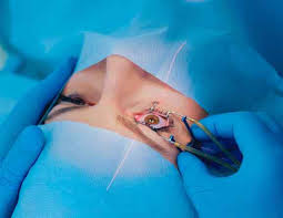 Best Femto LASIK Surgeon In Indirapuram Best Femto LASIK Surgeon In Indirapuram