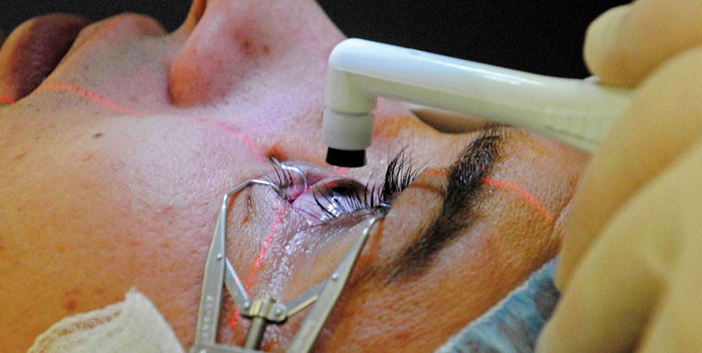 Cataract Eye Surgery