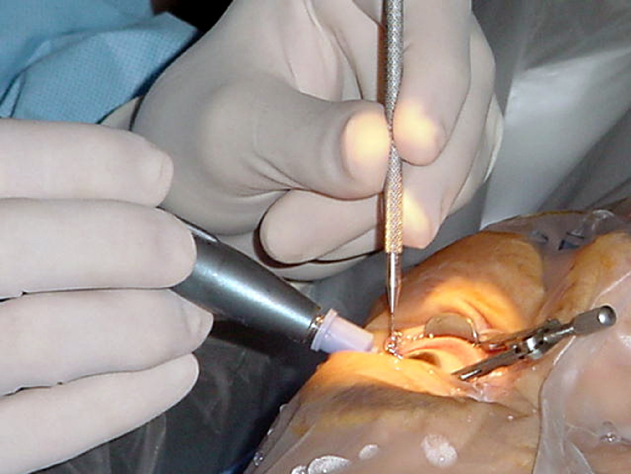 Cataract Treatment