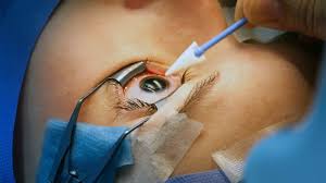 CLEAR Surgery