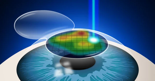 Contoura Vision - Specs Removal