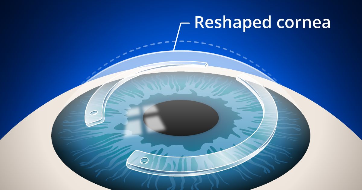 Cornea Treatment