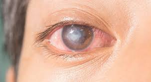 Corneal Care Corneal Care