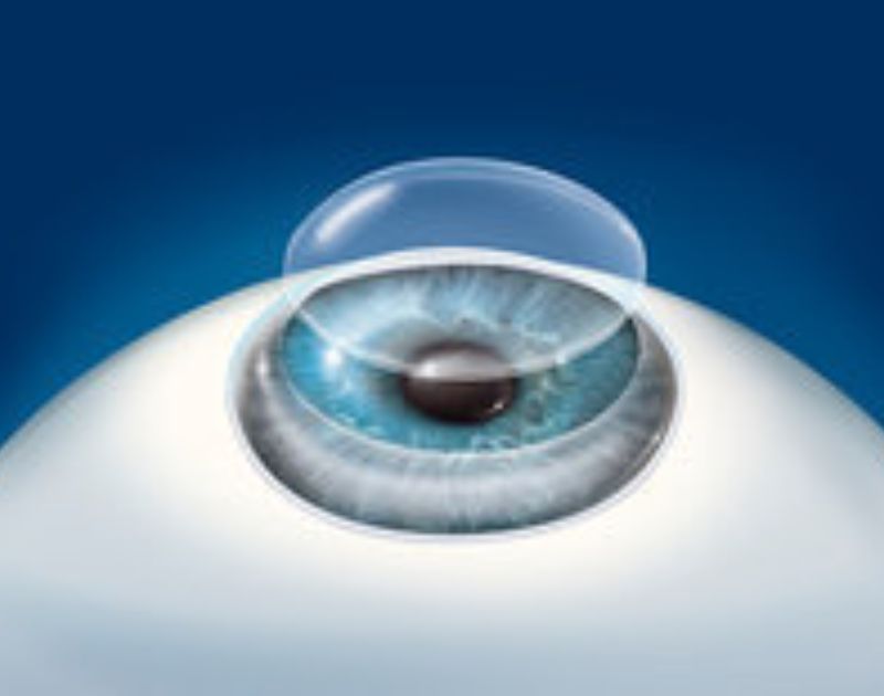 Corneal Transplant