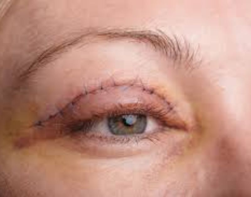 Eyelid Surgery Eyelid Surgery