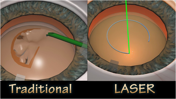 Femto Cataract Surgery