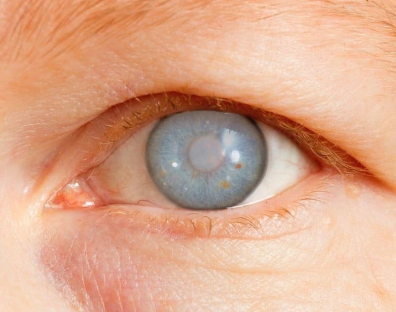 Glaucoma Treatment