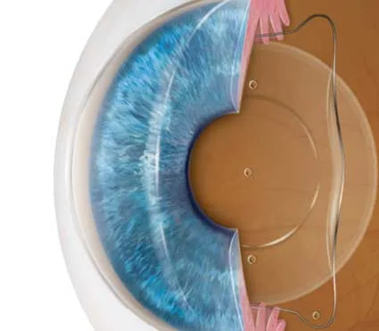 Implantable Contact Lens (ICL)