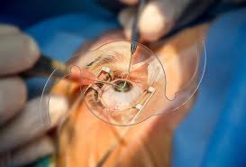 IOL Surgery