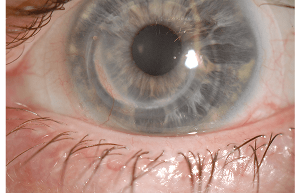 Keratoconus