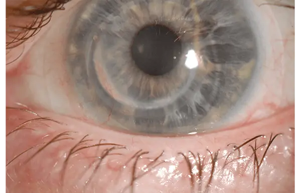 Keratoconus