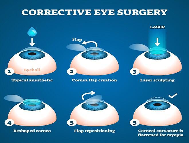 Lasik Surgery