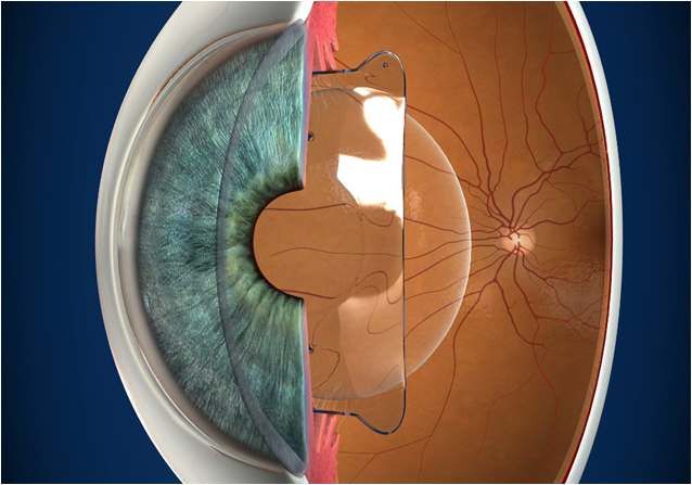 Refractive Surgery