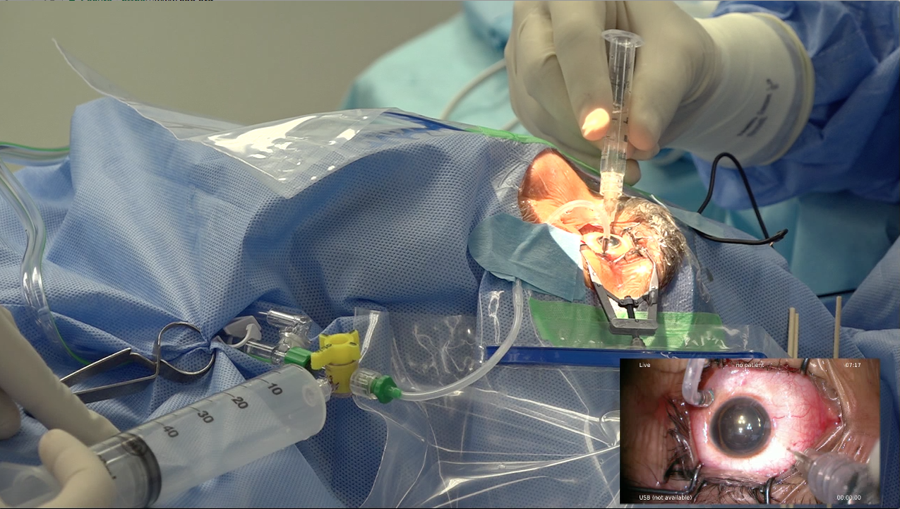 Retinal Detachment Surgery