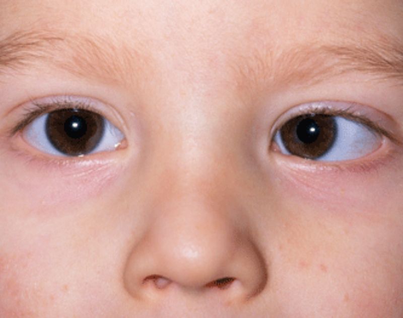  Squint Or Strabismus