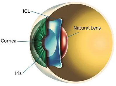 Implantable Collamer Lens (ICL)
